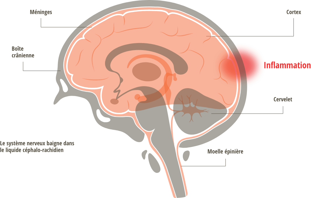 Inflammation du cerveau